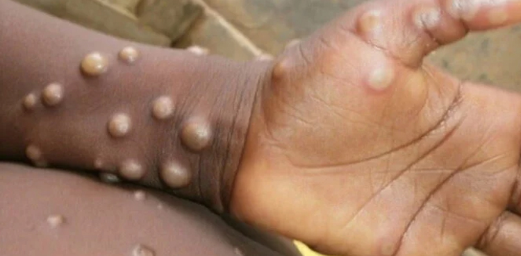 WHO declares mpox a global public health emergency