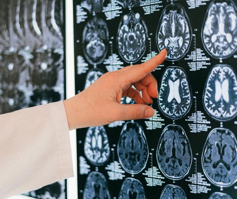 only 15 neurosurgeons are available across eight public hospitals in sindh which receive a daily influx of more than a 1000 patients with brain and spinal injuries photo pexels